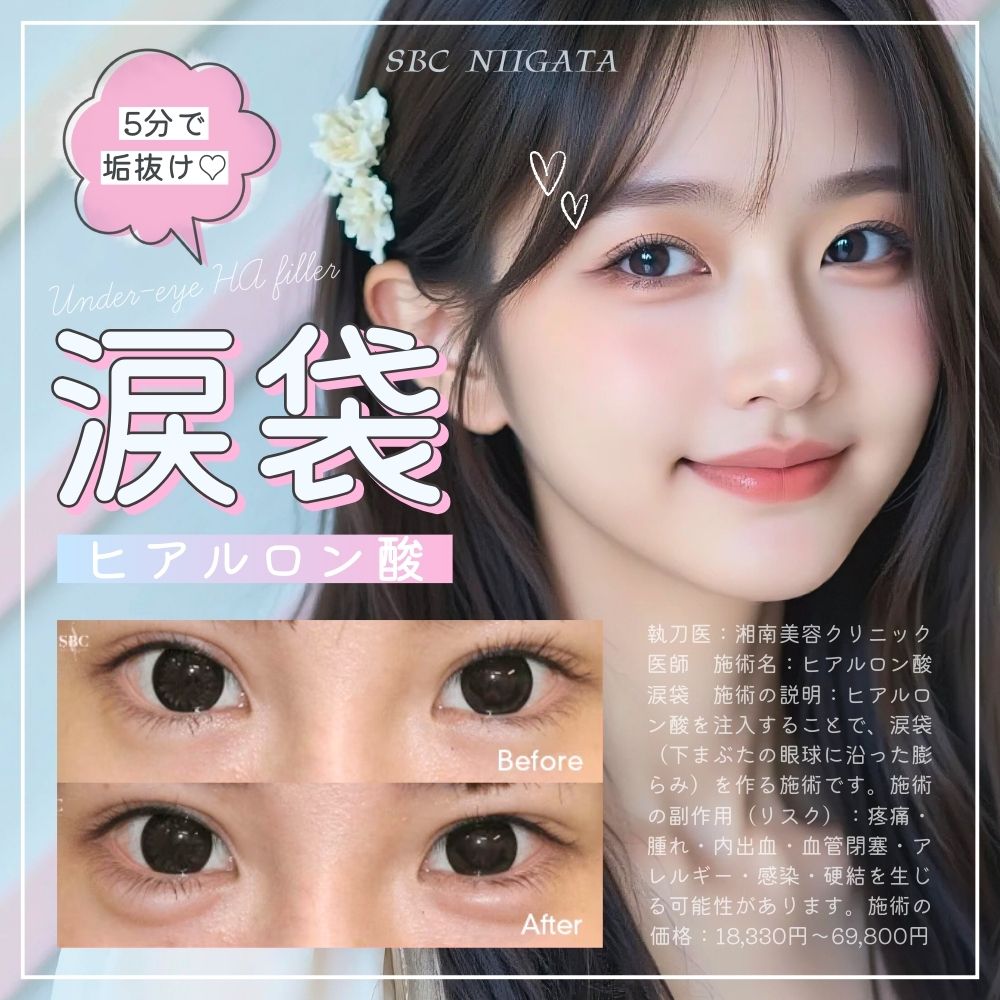 【涙袋ヒアルロン酸｜新潟】5分で垢抜け！10代・20代に人気の理由｜効果・持続・痛みを解説